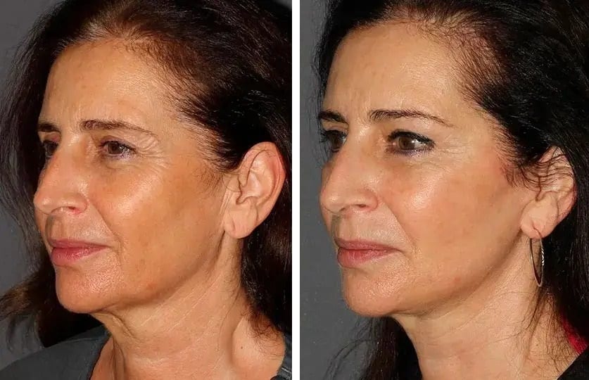 Lifting de cuello caso 5 — antes y después